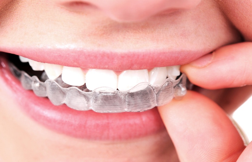 Teeth Aligners Fix